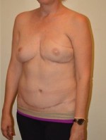 Breast Reconstruction