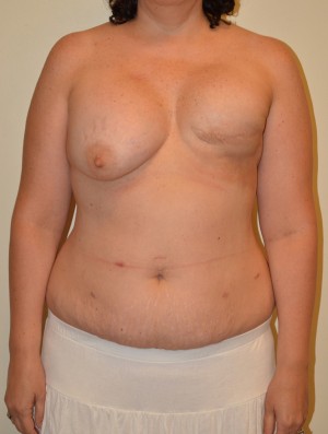 Breast Reconstruction Case 3722 Before Photo Breast Reconstruction