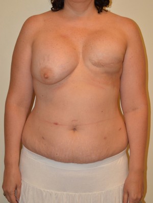 Breast Reconstruction