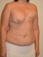 Breast Reconstruction