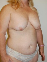 Breast Reconstruction