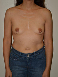 Breast Reconstruction