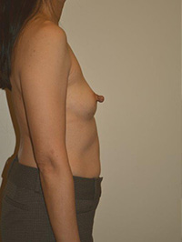 Breast Reconstruction