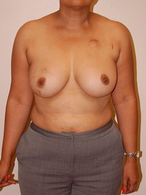 Breast Reconstruction Case 3754 Before Photo Breast Reconstruction