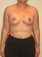 Breast Reconstruction