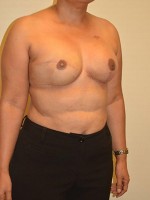 Breast Reconstruction