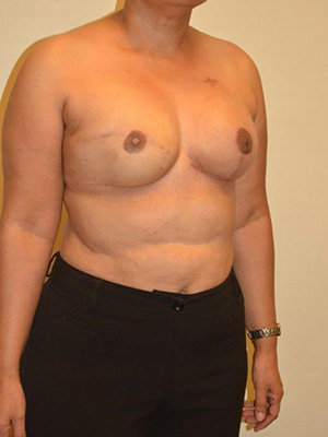 Breast Reconstruction Case 3754 After Photo Breast Reconstruction