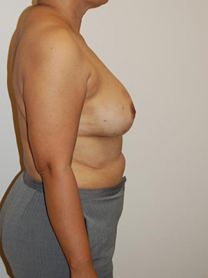 Breast Reconstruction Case 3754 Before Photo Breast Reconstruction