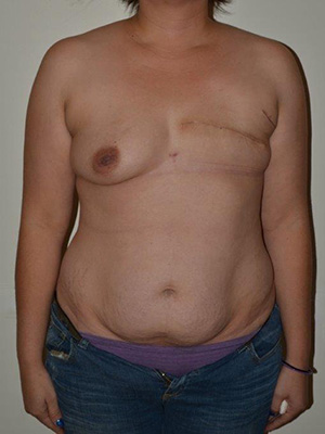 Breast Reconstruction Case 3762 Before Photo Breast Reconstruction