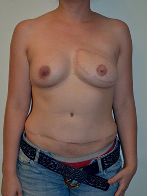 Breast Reconstruction Case 3762 After Photo Breast Reconstruction