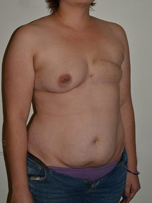 Breast Reconstruction Case 3762 Before Photo Breast Reconstruction