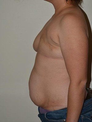 Breast Reconstruction Case 3762 Before Photo Breast Reconstruction