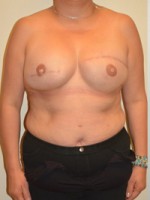 Breast Reconstruction