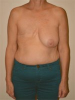 Breast Reconstruction