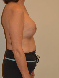 Breast Reconstruction Case 3778 After Photo Breast Reconstruction