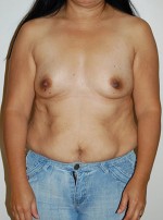 Breast Reconstruction