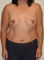 Breast Reconstruction