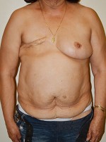 Breast Reconstruction