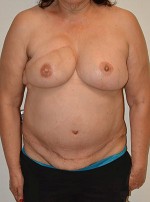 Breast Reconstruction