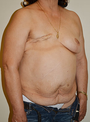 Breast Reconstruction Case 3794 Before Photo Breast Reconstruction