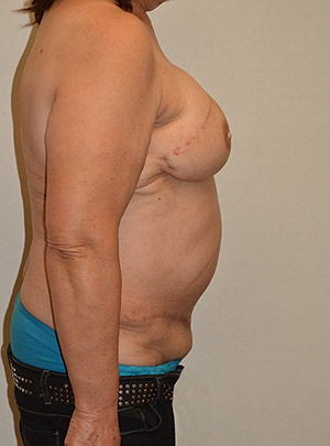 Breast Reconstruction Case 3794 After Photo Breast Reconstruction