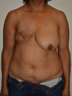 Breast Reconstruction