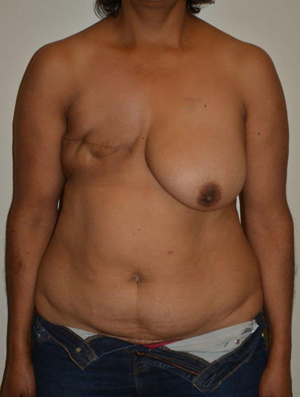 Breast Reconstruction Case 3802 Before Photo Breast Reconstruction