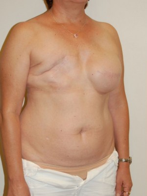 Breast Reconstruction Case 3808 Before Photo Breast Reconstruction
