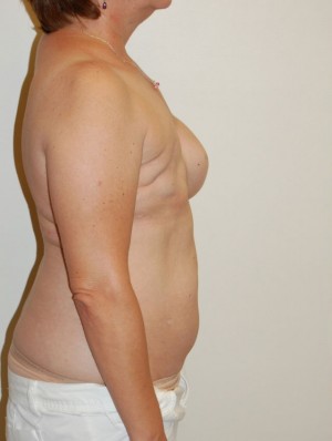 Breast Reconstruction Case 3808 Before Photo Breast Reconstruction