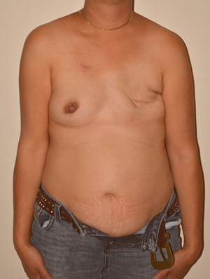 Breast Reconstruction