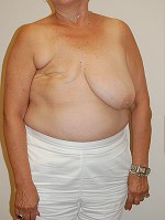 Breast Reconstruction