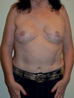 Breast Reconstruction