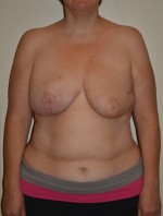 Breast Reconstruction