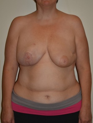 Breast Reconstruction Case 3848 After Photo Breast Reconstruction