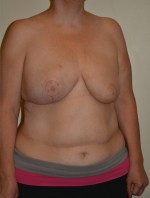 Breast Reconstruction