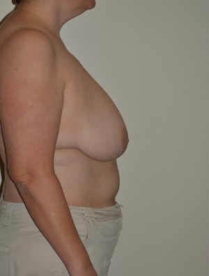 Breast Reconstruction Case 3848 Before Photo Breast Reconstruction