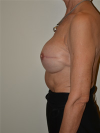 Breast Reconstruction