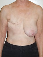 Breast Reconstruction