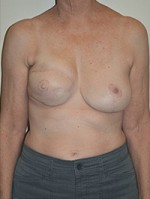 Breast Reconstruction