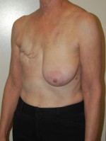 Breast Reconstruction