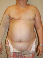 Breast Reconstruction