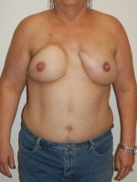 Breast Reconstruction