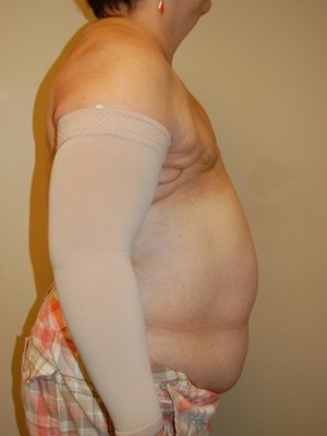 Breast Reconstruction Case 3872 Before Photo Breast Reconstruction