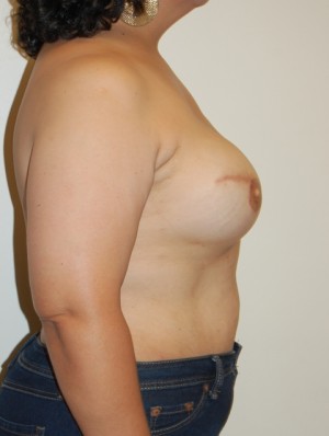 Breast Reconstruction Case 3904 After Photo Breast Reconstruction