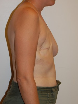 Breast Reconstruction Case 3912 Before Photo Breast Reconstruction