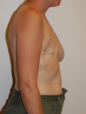 Breast Reconstruction