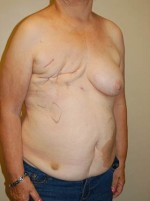 Breast Reconstruction