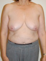 Breast Reconstruction