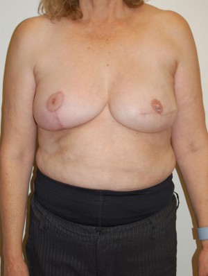 Breast Reconstruction Case 3928 After Photo Breast Reconstruction