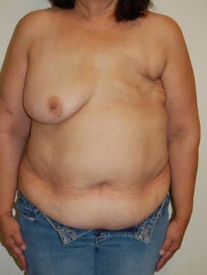 Breast Reconstruction Case 3944 Before Photo Breast Reconstruction